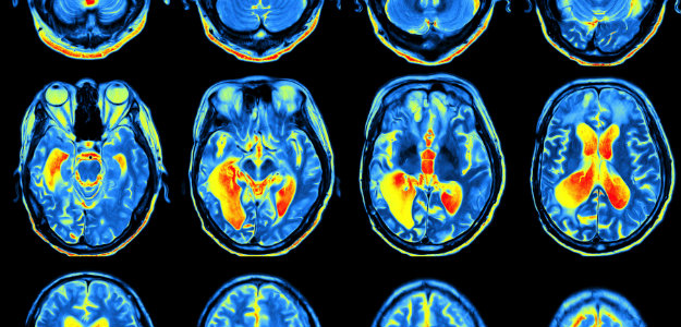 Cerebral Atrophy: Causes, Symptoms, Treatment – Latest Health Report